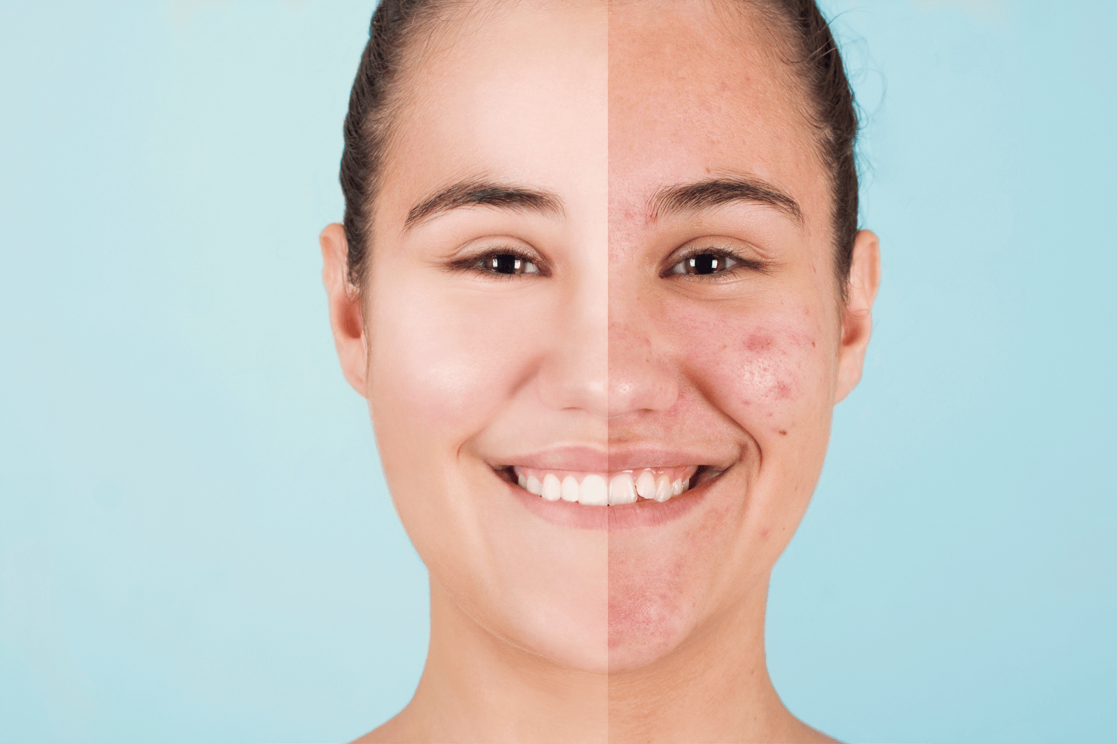 Flawless and Fearless Picks: Top 7 Best Makeup For Acne Prone Skin